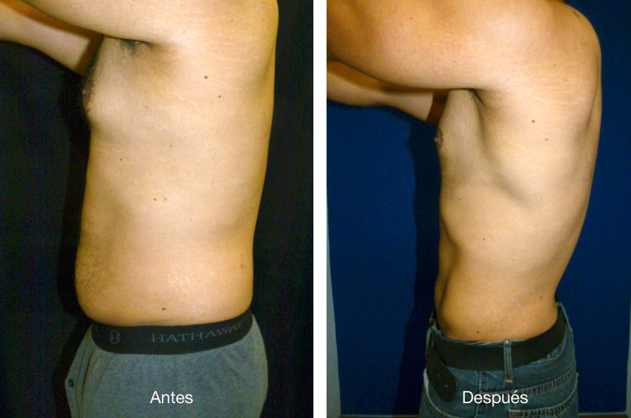 lipoescultura-caso-2-1