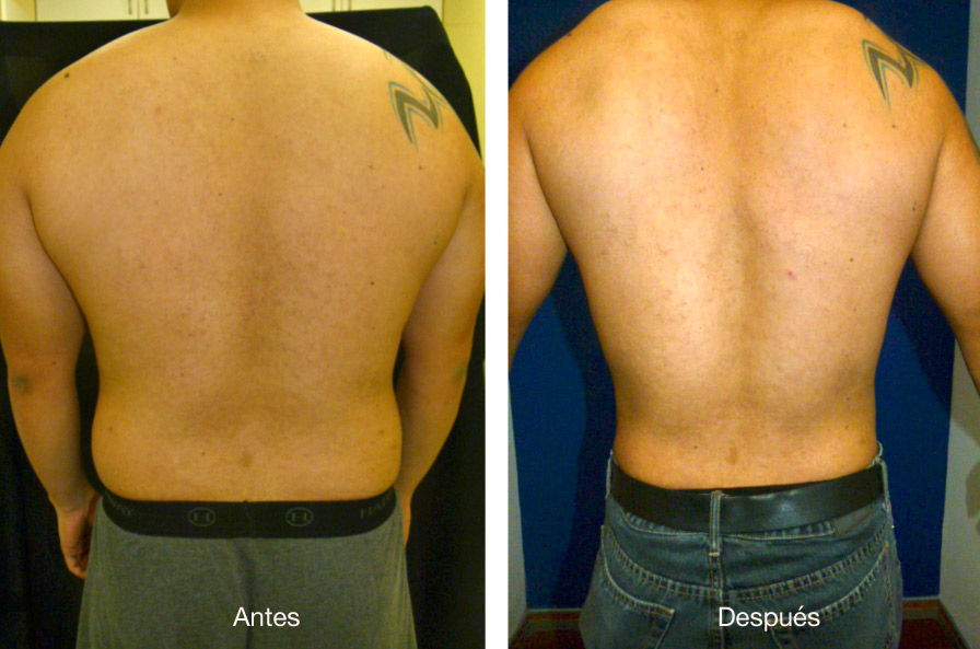 lipoescultura-caso-2-3