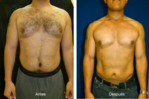 lipoescultura-caso-2