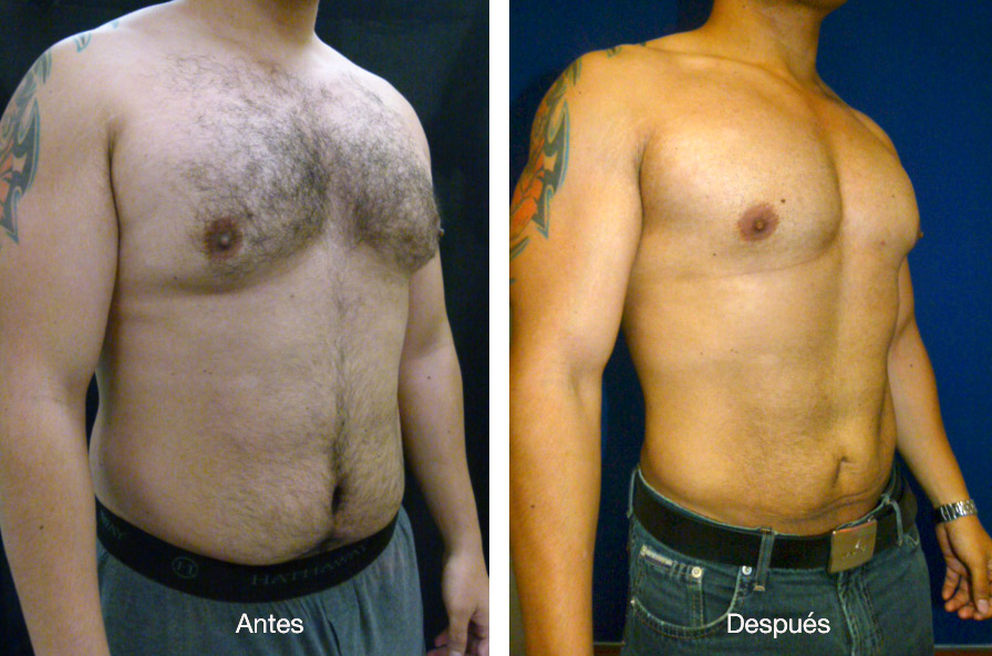 lipoescultura-caso-2-4