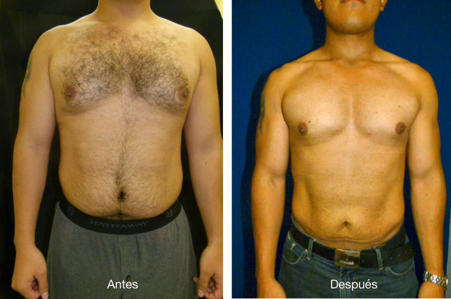 lipoescultura-caso-2