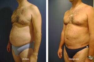 lipoescultura-caso-3-1