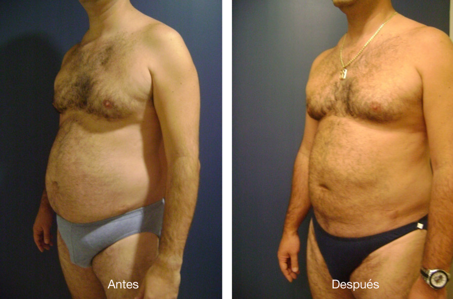 lipoescultura-caso-3-1