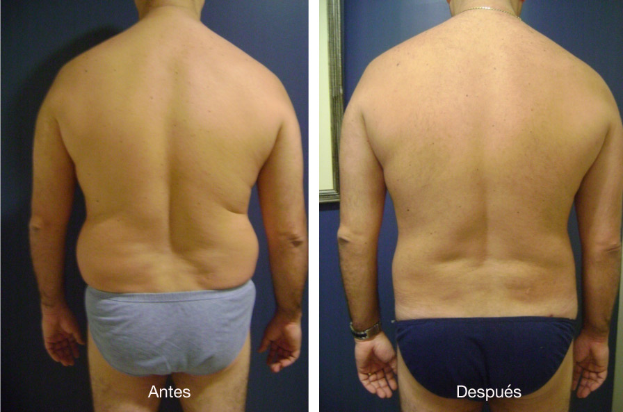 lipoescultura-caso-3-3