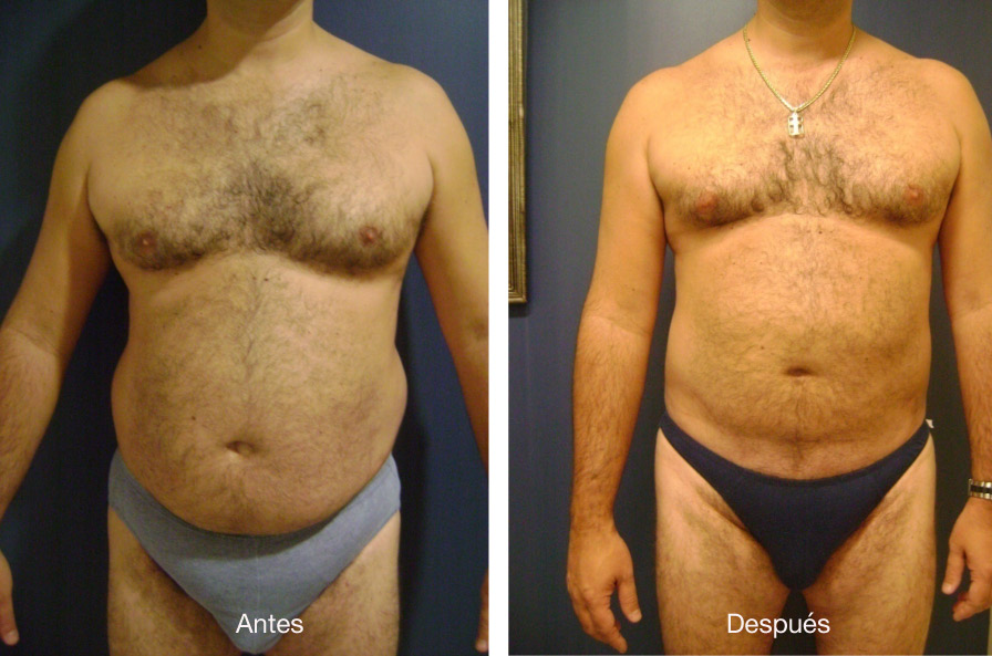 lipoescultura-caso-3