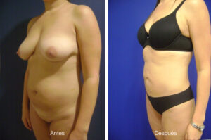 lipoescultura-caso-4-1