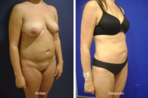 lipoescultura-caso-4-3