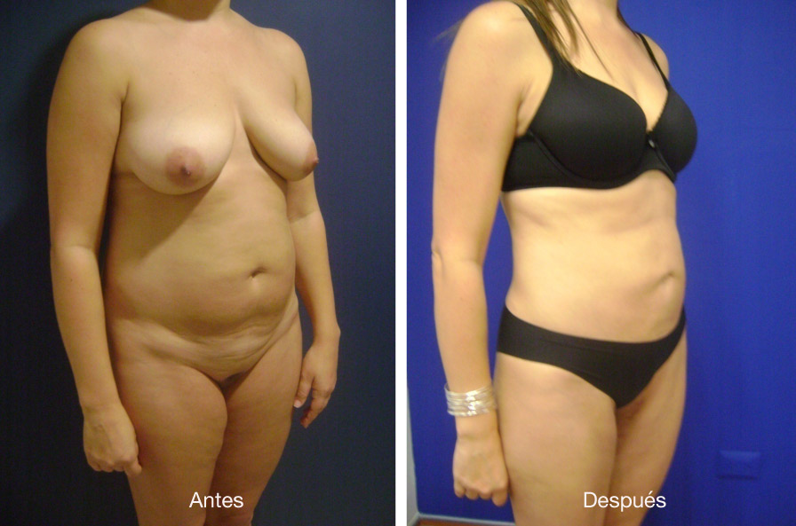 lipoescultura-caso-4-3