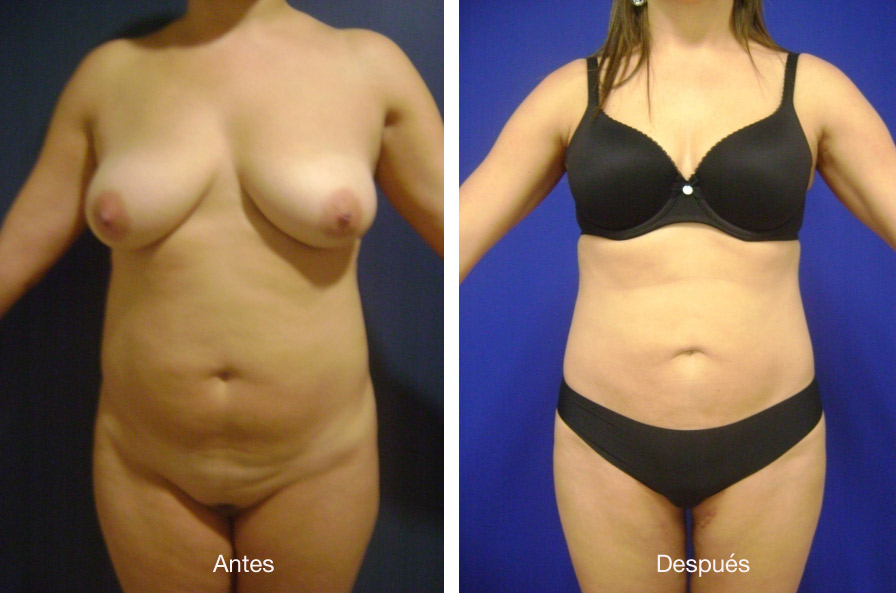 lipoescultura-caso-4