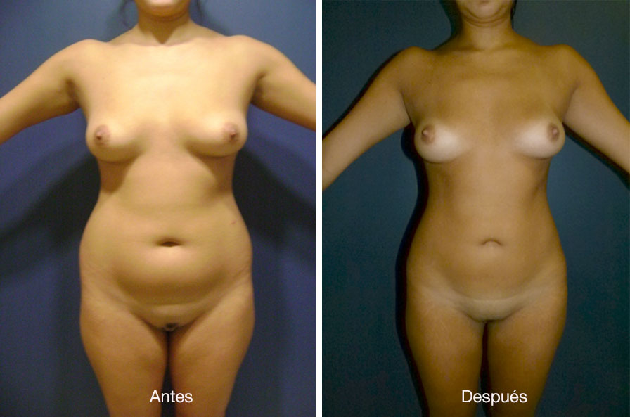 lipoescultura-dr-meneses-1