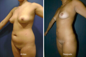 lipoescultura-dr-meneses-2