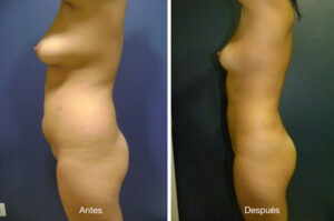 lipoescultura-dr-meneses-3