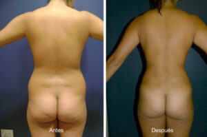 lipoescultura-dr-meneses-4