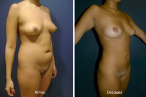 lipoescultura-dr-meneses-5