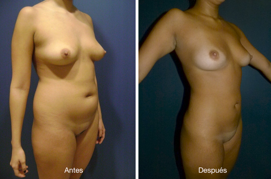 lipoescultura-dr-meneses-5