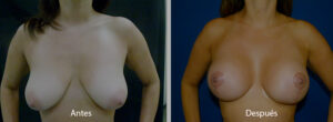 reduccion-mamaria-1