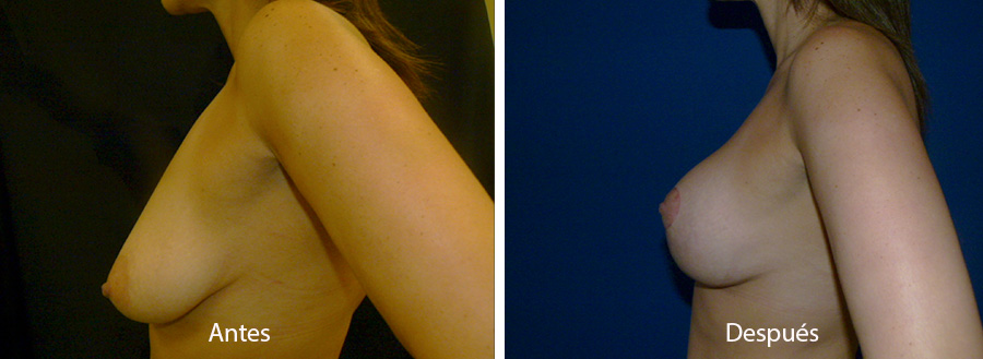 reduccion-mamaria-4