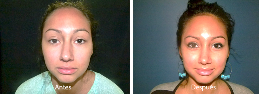 rinaplastia-drmeneses-1