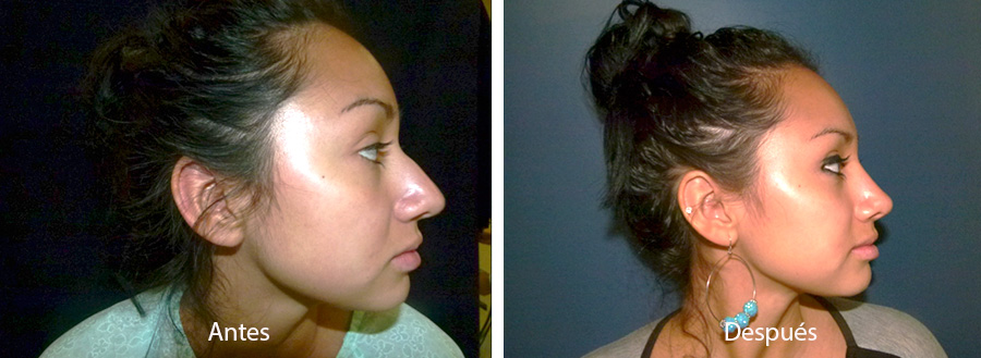 rinaplastia-drmeneses-2