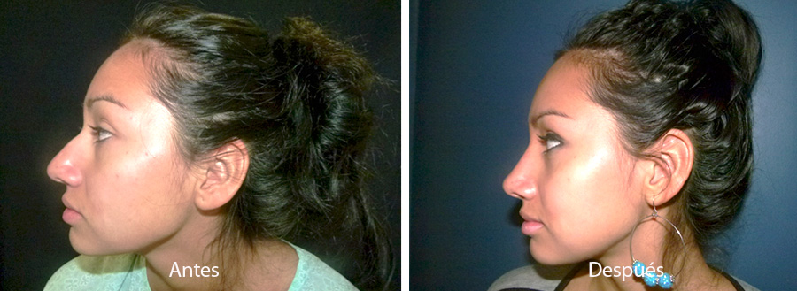 rinaplastia-drmeneses-3