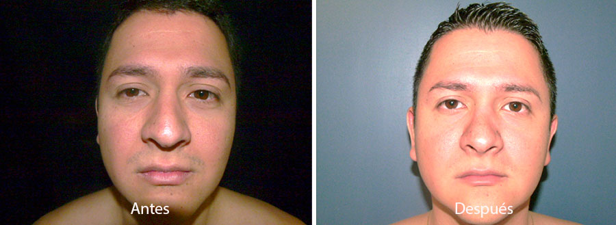 rinaplastia-drmeneses-4