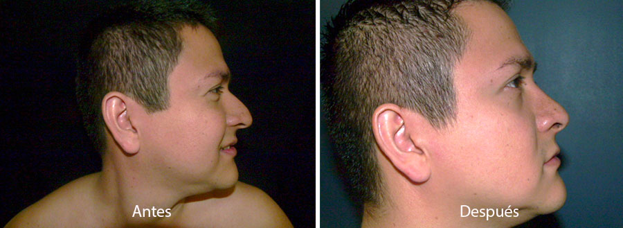 rinaplastia-drmeneses-5