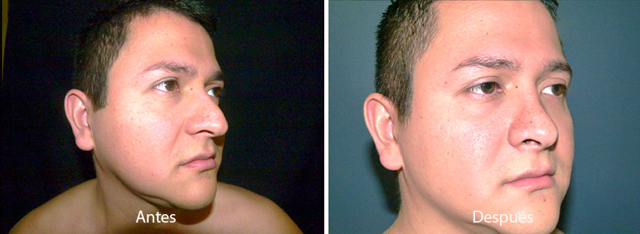 rinaplastia-drmeneses-6