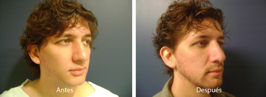 rinoplastia11