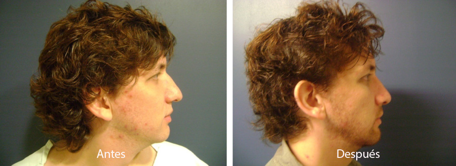 rinoplastia12