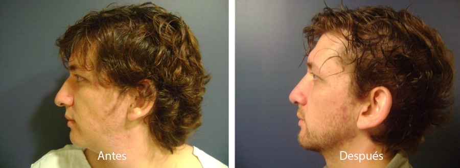 rinoplastia13