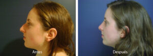rinoplastia15