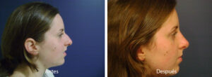rinoplastia16