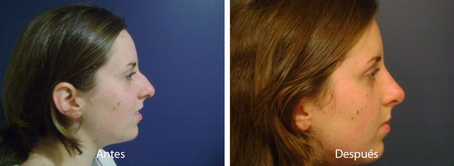 rinoplastia16