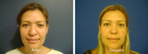 rinoplastia17