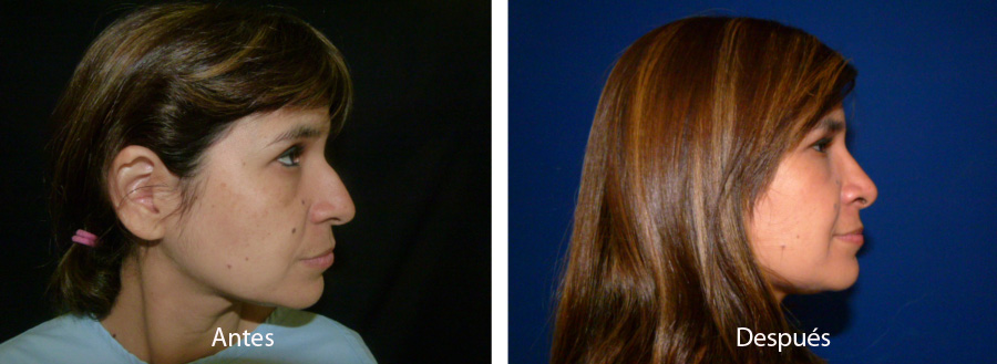 rinoplastia20