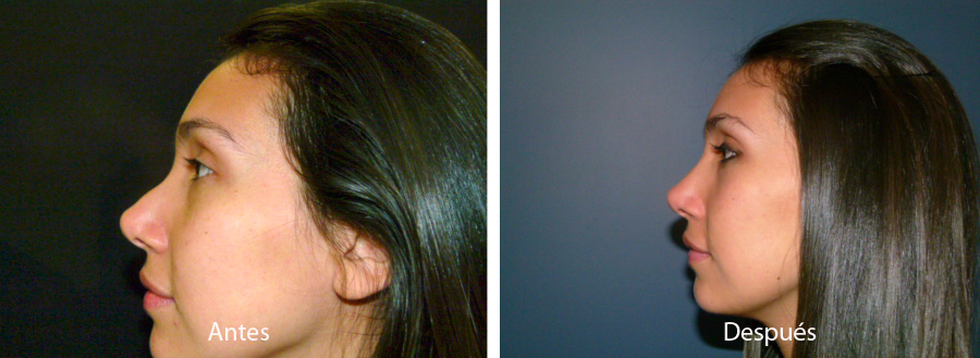 rinoplastia27