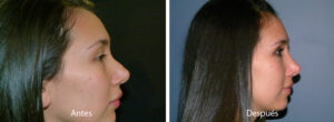 rinoplastia28
