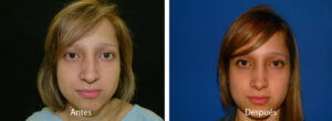 rinoplastia29