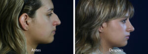 rinoplastia3