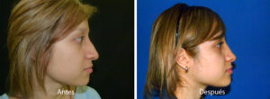 rinoplastia30