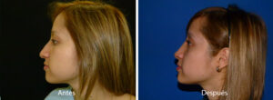 rinoplastia31