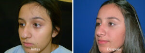 rinoplastia32