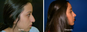 rinoplastia33