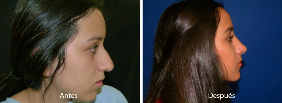 rinoplastia33