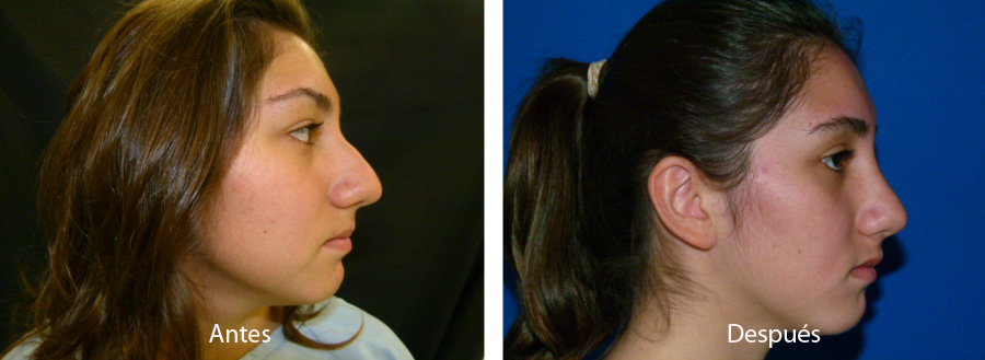 rinoplastia35