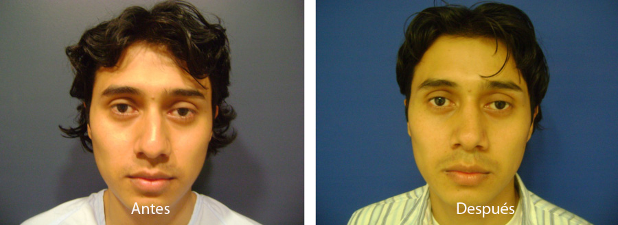 rinoplastia36