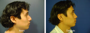 rinoplastia37