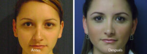 rinoplastia4