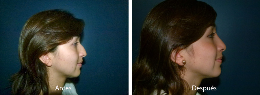 rinoplastia40