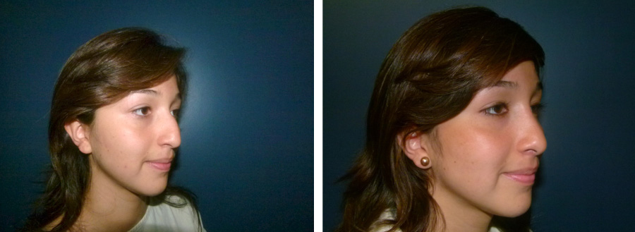 rinoplastia42